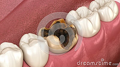 Molar teeth damaged by caries. Medically accurate tooth animation. Molar teeth damaged by caries. Medically accurate tooth 3D animation royalty free illustration