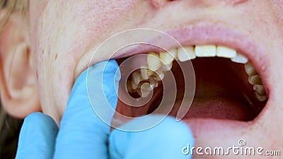 The hole in the tooth and the treatment of dental canals. Treatment of periodontitis in the dental clinic. Treatment of periodontitis in the dental clinic. The stock video