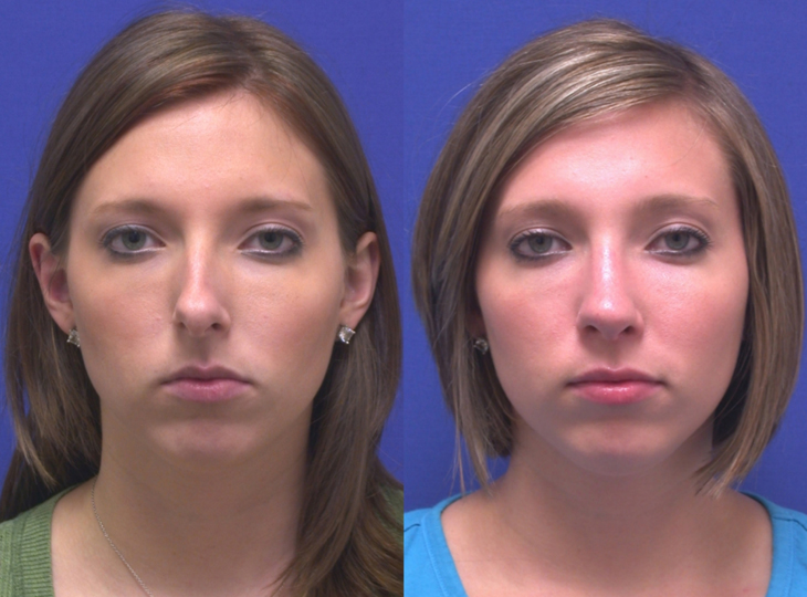 фото до и после косметологических процедур