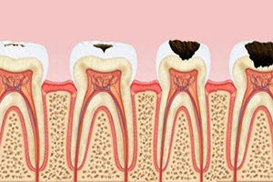 развитие заболевания зуба