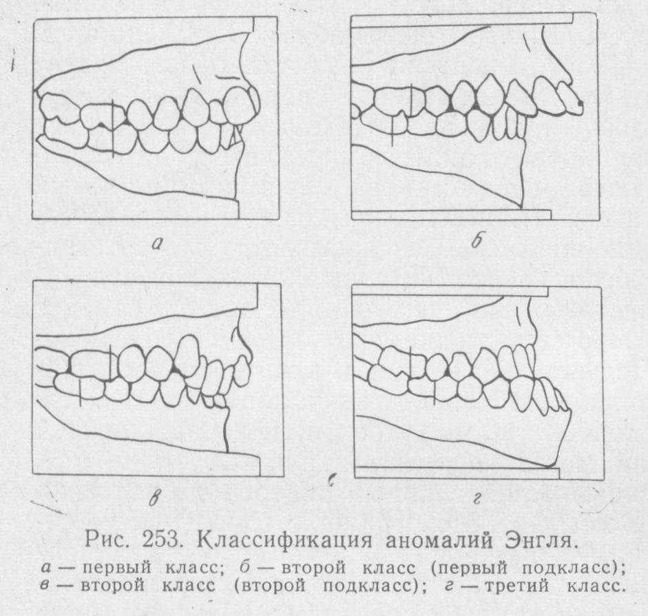 Окклюзия справа. Классификация Энгля прикус. Классификация аномалий окклюзии Энгля. Аномалии окклюзии по Энглю. Классификация аномалий зубов, зубных рядов и прикуса Энгля.