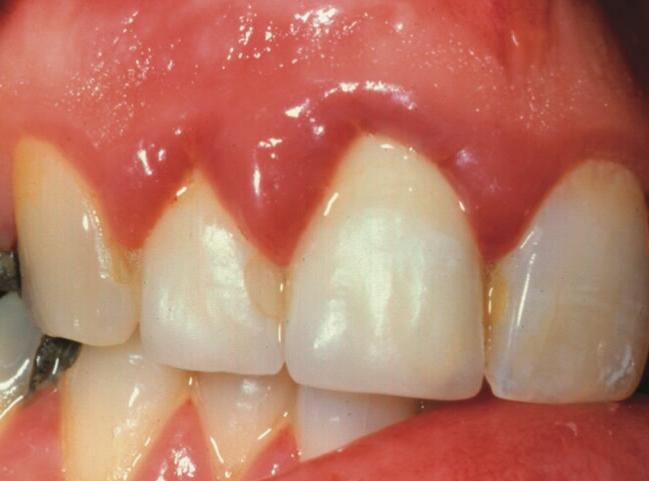 how to treat inflammation of the gums
