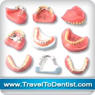 diversi tipi di protesi dentali
