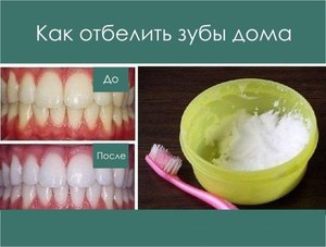 Действие соды при чистки зубов