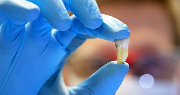 Как пережить первые 24 часа после удаления зуба