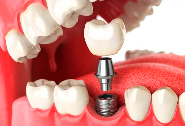 5 особенностей одноэтапной имплантации зубов