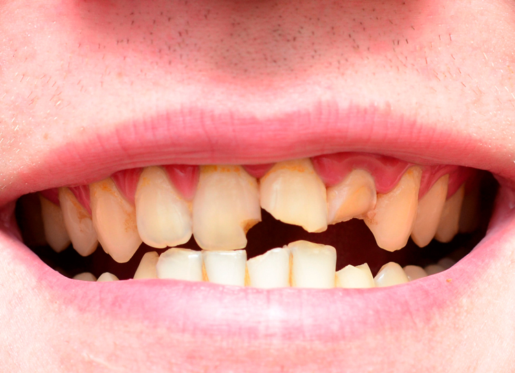 5 полезных советов для тех, у кого крошатся зубы
