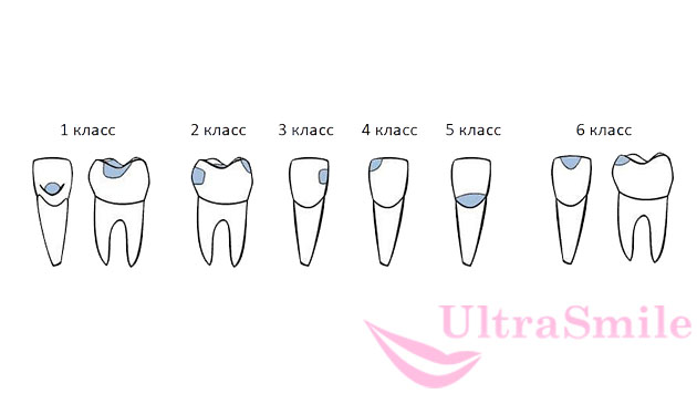 Пломба по блэку класс. Кариес по Блэку классификация в стоматологии. Классификация кариозных полостей по Блэку в стоматологии. Блэк классификация кариеса. Классификация Блэка 6 класс.