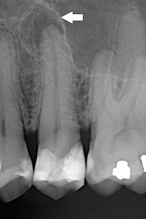 Chronic apical periodontitis.jpg
