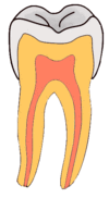 Pit-and-Fissure-Caries-GIF.gif