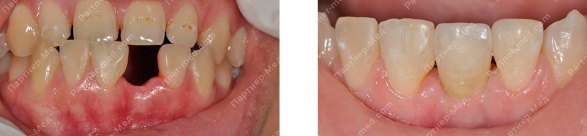 имплантация зубов нижней челюсти до и после