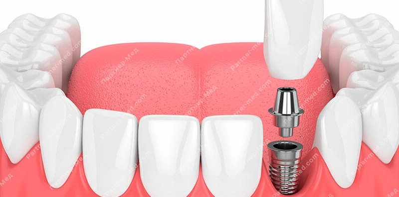 имплантация зубов нижней челюсти