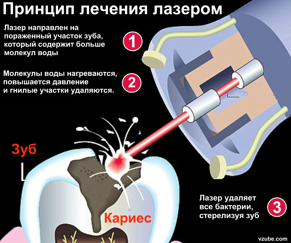 Лечение кариеса лазером Томск Радиостанция N16 Украшения на зубы Томск Кооперативный