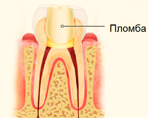 Где находится нерв в зубе фото