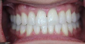 after teeth whitening