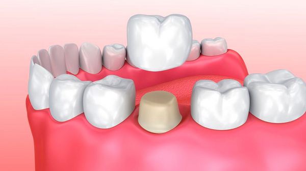 Протезирование при отсутствии зубов