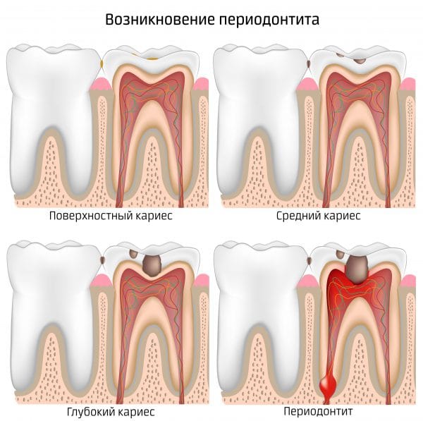 Возникновение периодонтита