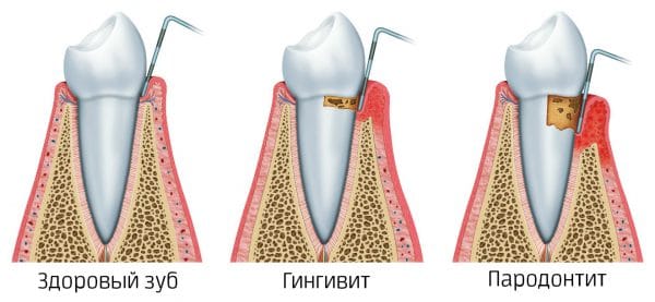 Пародонтит – заболевание тканей, окружающих зуб, опасно тем, что может привести к утрате вполне здоровых зубов