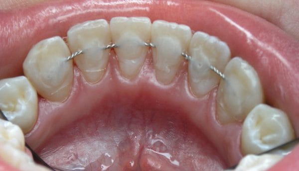 Шинирование зубов при пародонтите