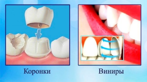 Коронки и виниры