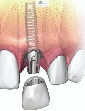 В результате несъёмное протезирование позволяет скрыть имеющиеся недостатки зубного ряда