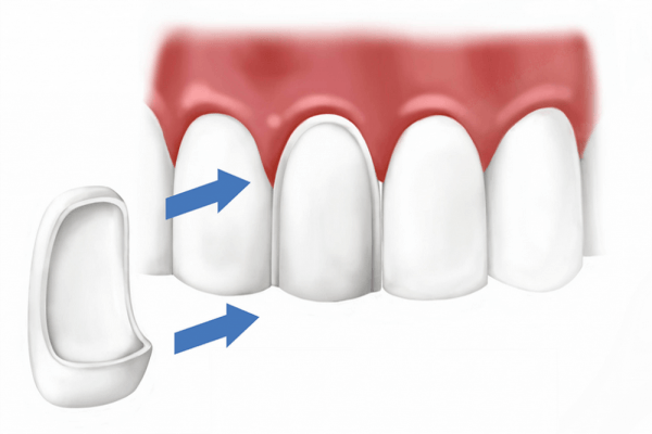 Виниры — представляют собой фарфоровые тонкие пластиночки, которые приклеиваются к зубу, закрывая поврежденную переднюю поверхность и скрывая дефекты