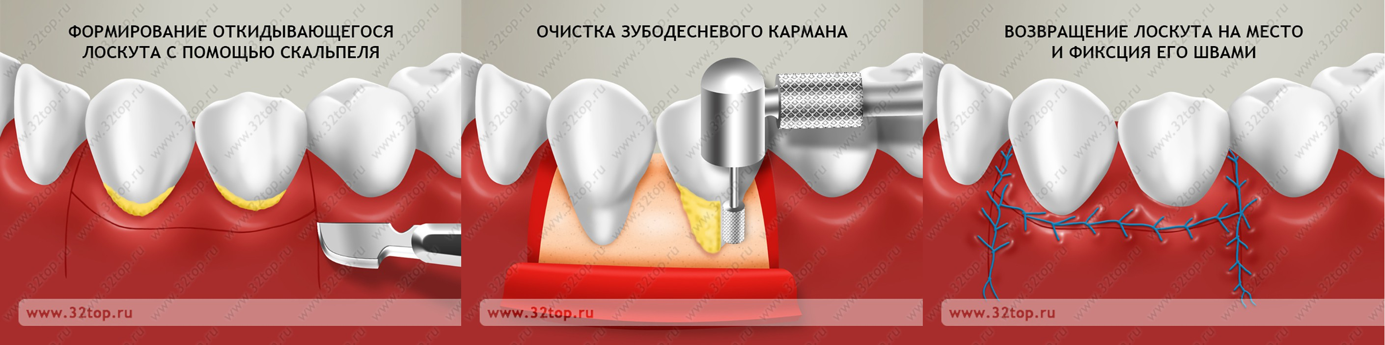 Лоскут зубы. Пародонтит Лоскутная операция. Лоскутная операция на деснах. Лоскутная операция в стоматологии. Лоскутная операция в области 1 зуба.