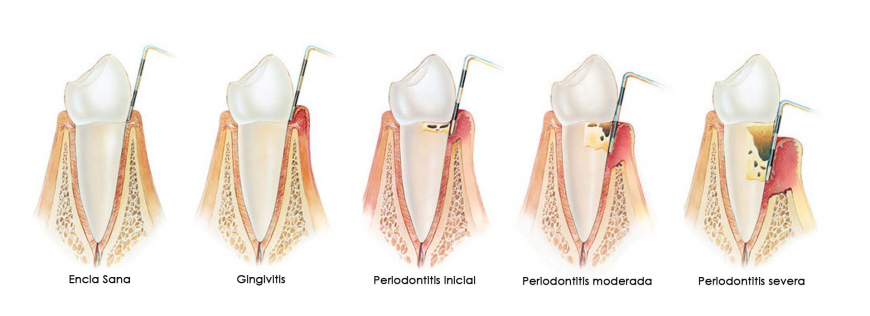 Признаки лечения зубов. Периодонтит воспаление десны. Болезни пародонта гингивит пародонтит пародонтоз. Пародонтит зубной камень.