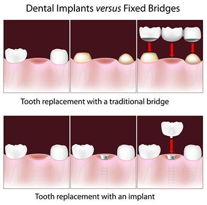 Tooth Loss Replacement in Mexico: Tooth Implant vs Bridge