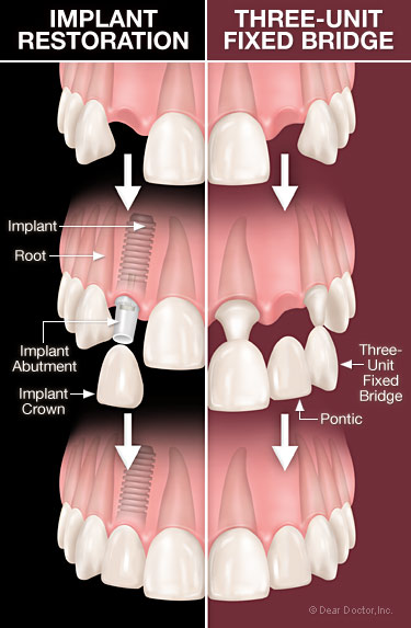 Dental implants vs bridgework