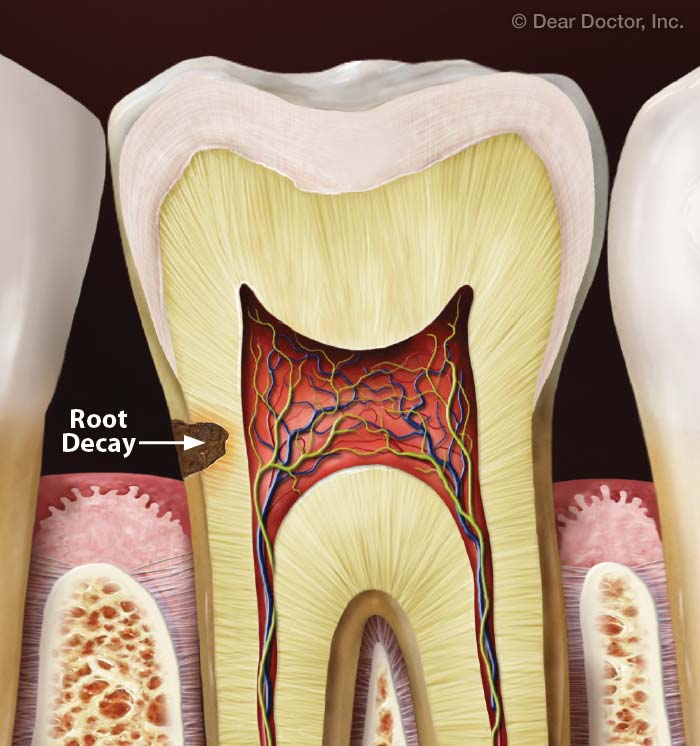 Root cavities.