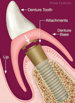 Denture attaches to dental implant.
