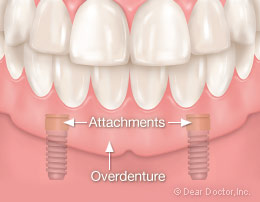Implant overdenture attachments.