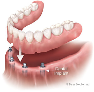 Denture with 4 dental implants.