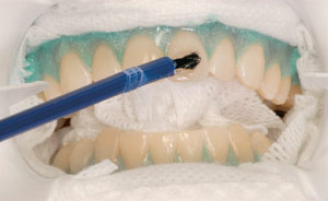 Applying teeth whitening solution with brush in dental office.