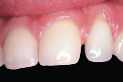 Dark tooth after teeth whitening.