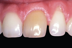 Dark tooth before teeth whitening.