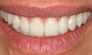 After periodontal plastic surgery.