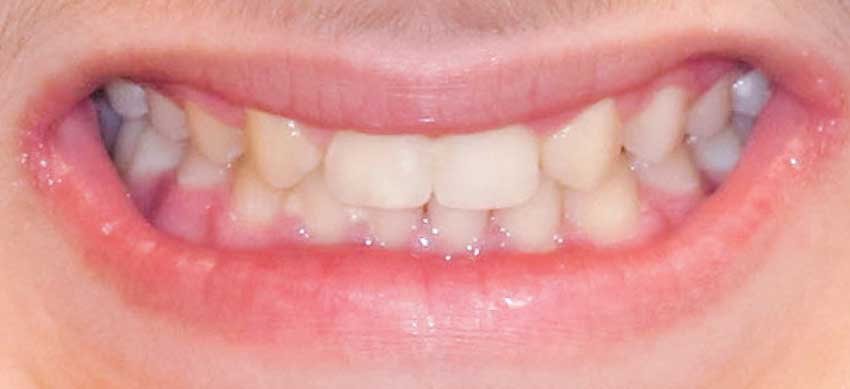 After - orthodontic treatment.
