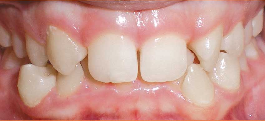 Before - missing lateral incisors.