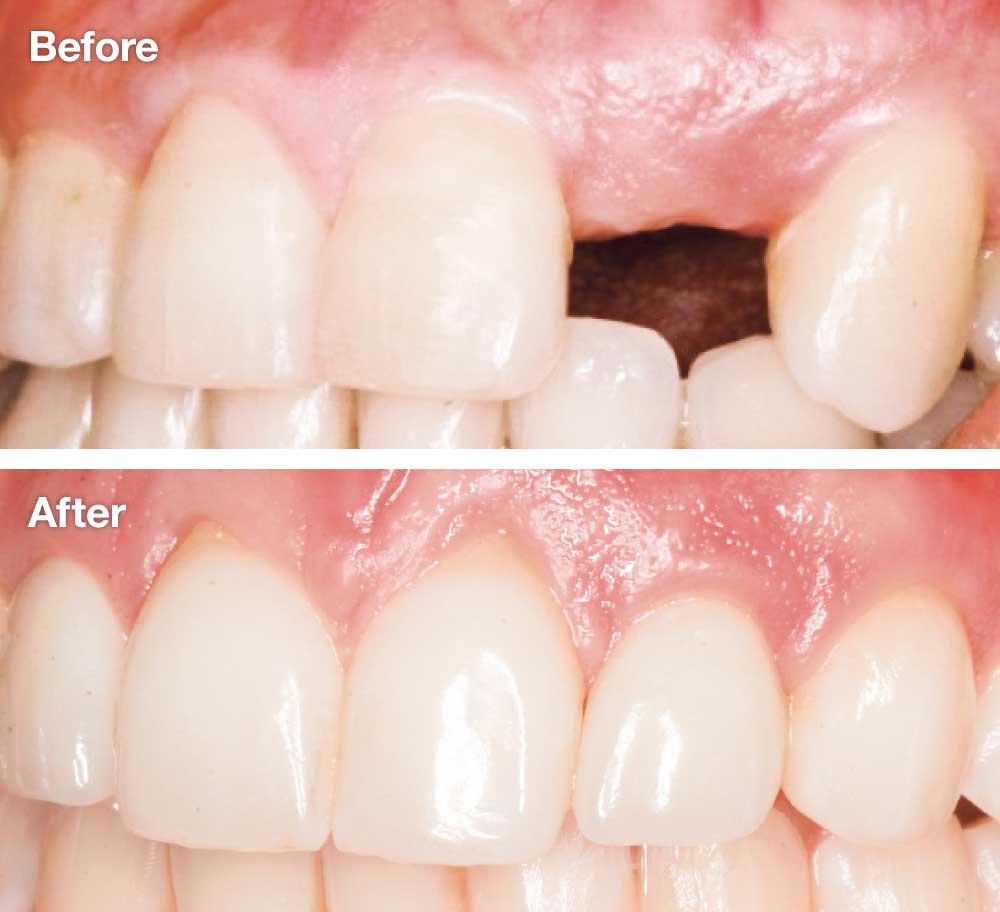 Missing lateral incisors - Before and after dental implants.
