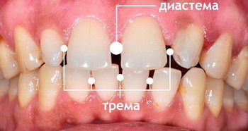 Тремы между зубами