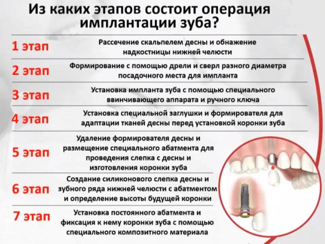 Можно ли после установки. Имплантация зубов этапы операции. Анализы для имплантации зубов. Этапы при имплантации зубов. Анализы перед имплантацией зубов список.