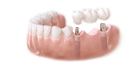 мост на имплантах на 3 зуба цена