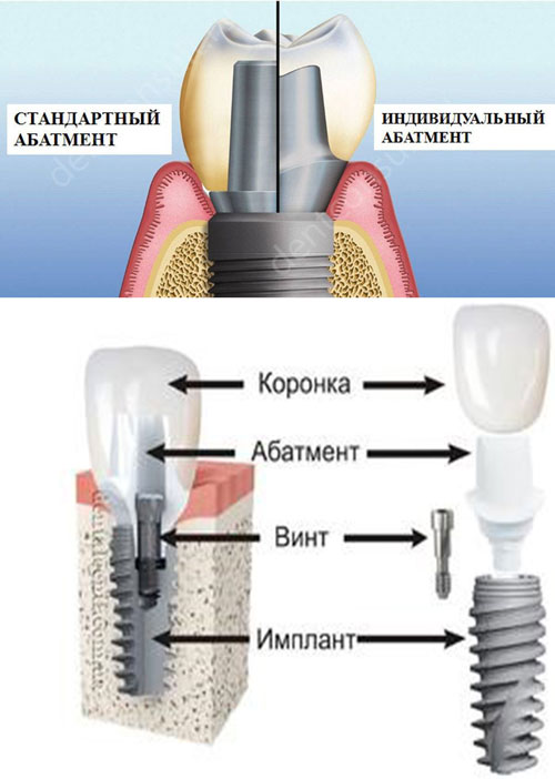Как выглядит временная коронка на имплант фото