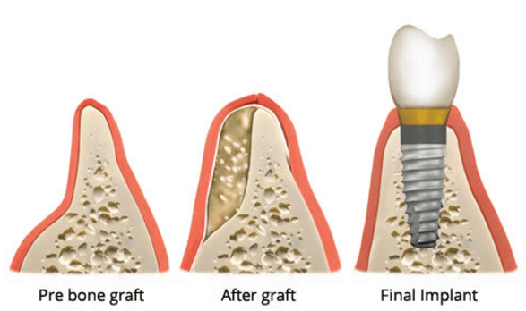 Implant Surgery Guide