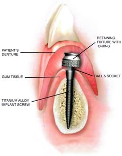 Mini Dental Implant Diagram