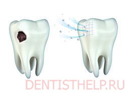 деминерализация эмали