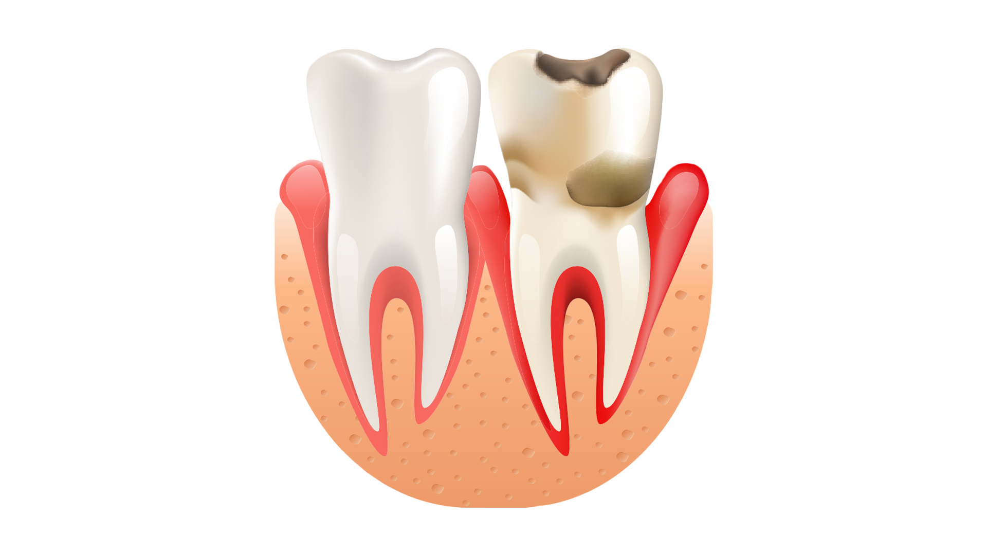 Признаки лечения зубов. Периодонтит 3 корневого зуба. Межкорневой периодонтит. Периодонтит и пародонтит. Мышьяковистый периодонтит.