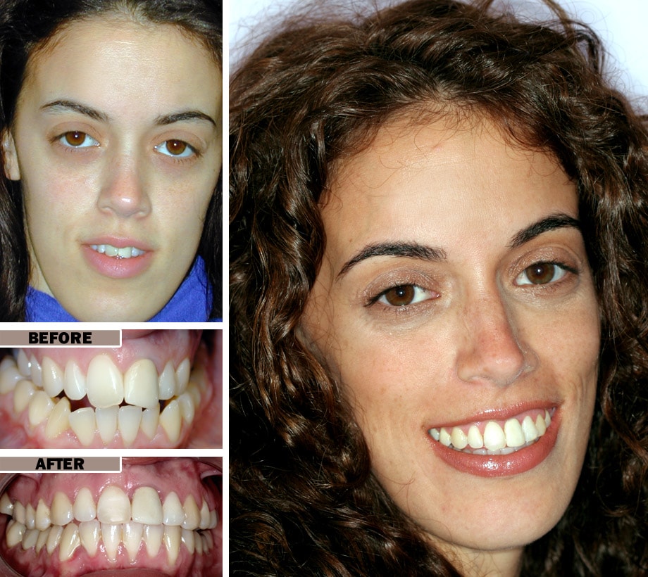 Видны передние зубы. Энн Хэтэуэй виниры. Исправление кривых зубов. Зубы до брекетов до и после.